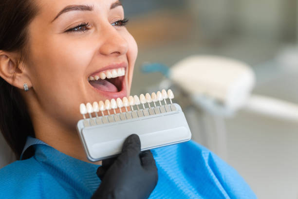 Mexico Dental Veneers The Smart Choice for a Flawless Smile