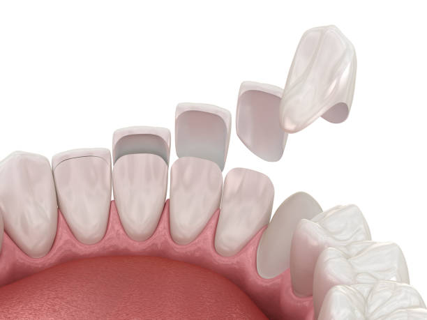 Dental Crowns in Tijuana Restore Your Smile with Precision and Care